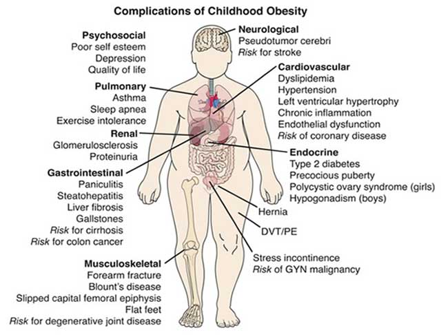 Diagram showing the possible areas of the human body that may suffer from illnesses and diseases related to childhood obesity.
